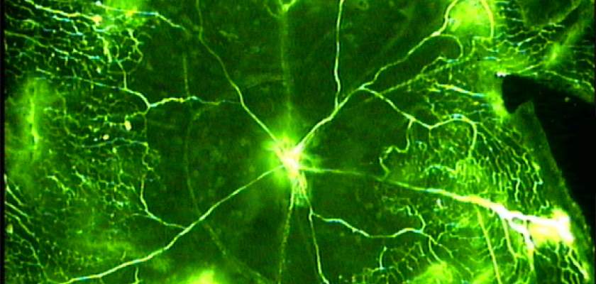 Retinopathy of prematurity