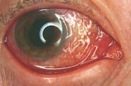 conjunctivitis