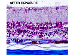 retinal degeneration induced