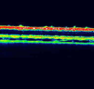 Ocular Neurodegeneration Models